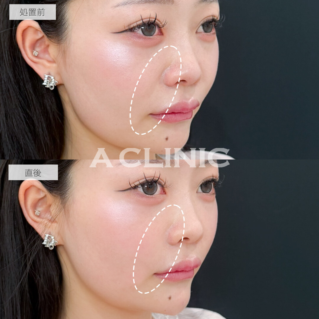 ヒアルロン酸カスタマイズメニューですっぴんでも盛れるメリハリのあるお顔に変化！処置前と直後の症例です(20代女性)