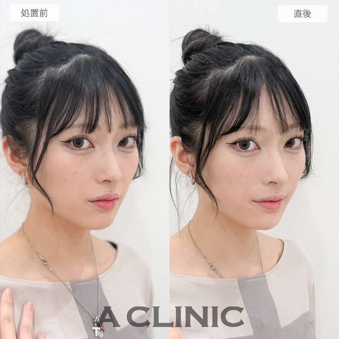 ヒアルロン酸カスタマイズメニューで凹凸なくして丸みのある整った輪郭に修正！処置前と直後の症例です(20代女性)