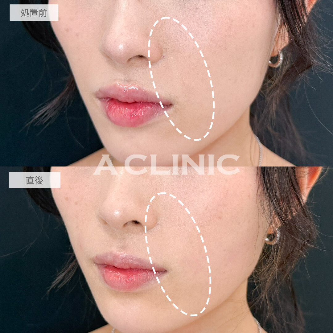ヒアルロン酸カスタマイズメニューで凹凸なくして丸みのある整った輪郭に修正！処置前と直後の症例です(20代女性)