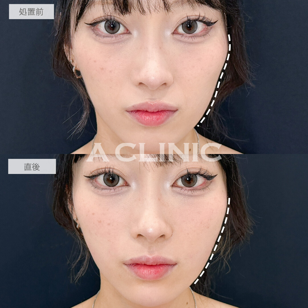 ヒアルロン酸カスタマイズメニューで凹凸なくして丸みのある整った輪郭に修正！処置前と直後の症例です(20代女性)