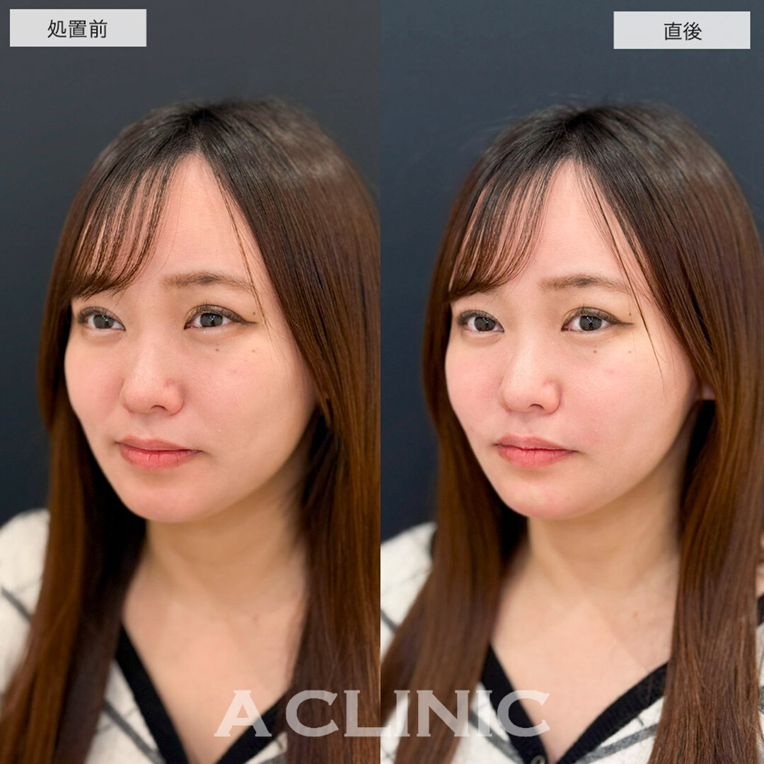 ヒアルロン酸カスタマイズメニューでほうれい線が薄くなりバランスが整いました!こちら処置前と直後の症例です(20代女性)