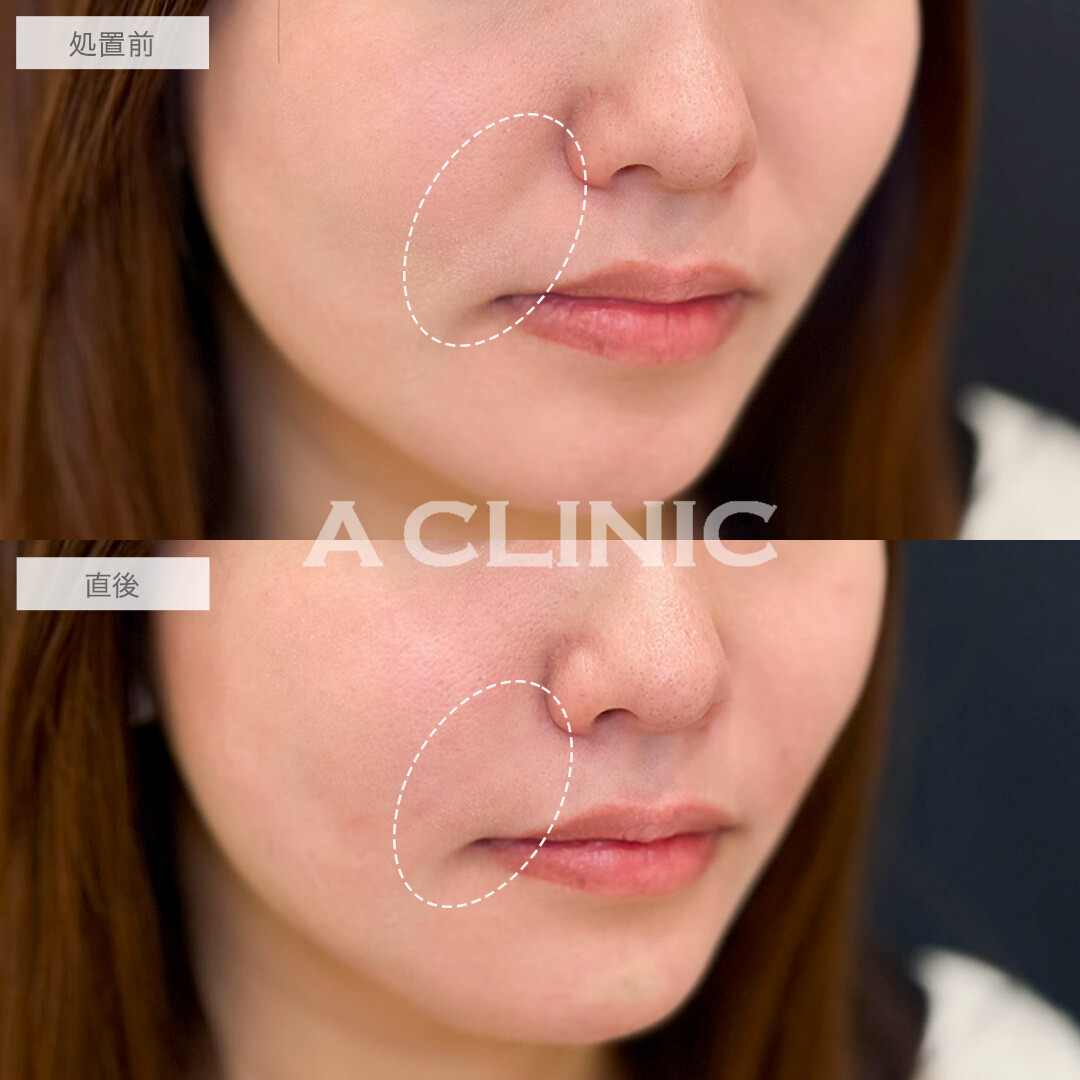 ヒアルロン酸カスタマイズメニューでほうれい線が薄くなりバランスが整いました!こちら処置前と直後の症例です(20代女性)