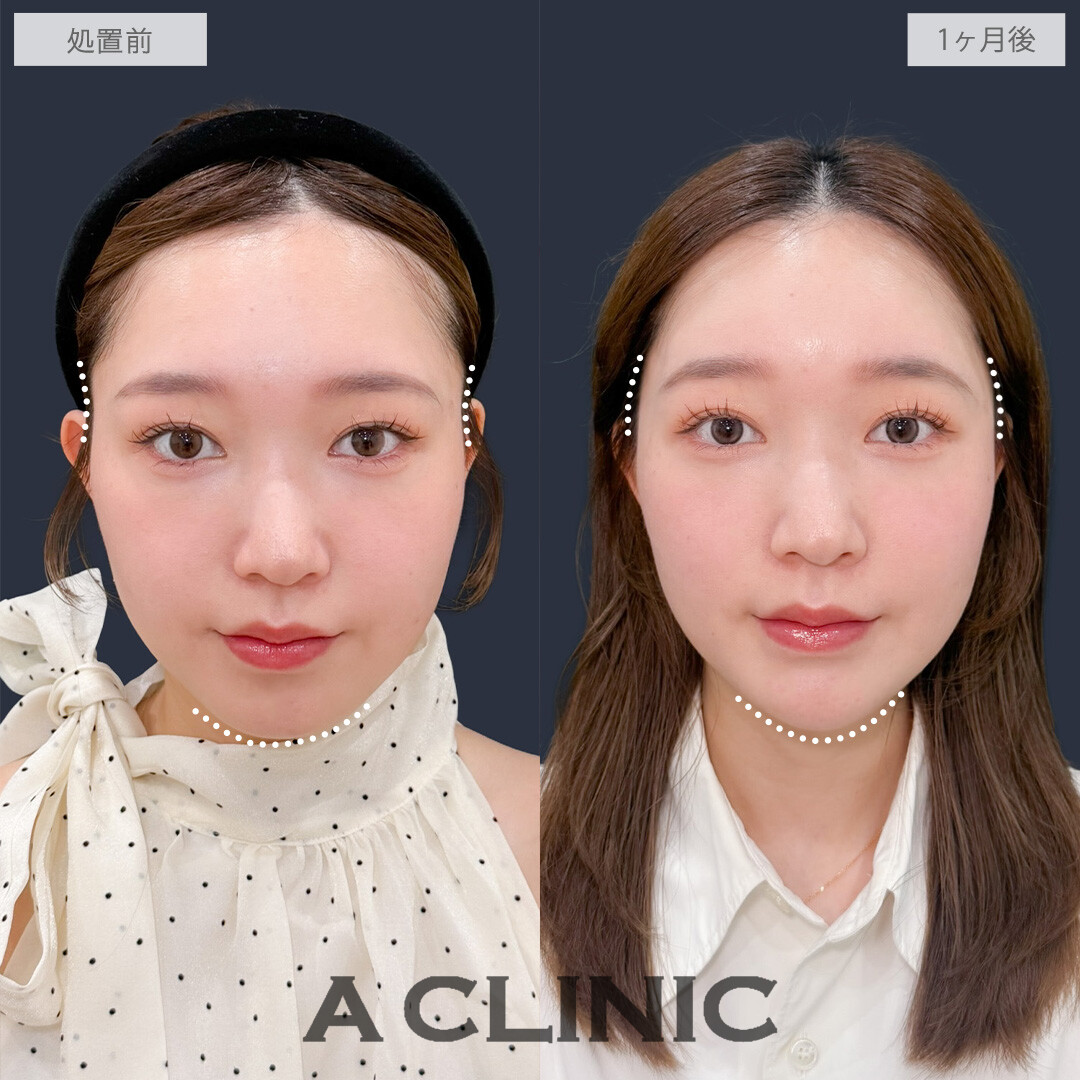 ヒアルロン酸カスタマイズメニューで凹みなくしてどの角度から見ても美しくなりました！こちら処置前と1ヶ月後の症例です(20代女性)