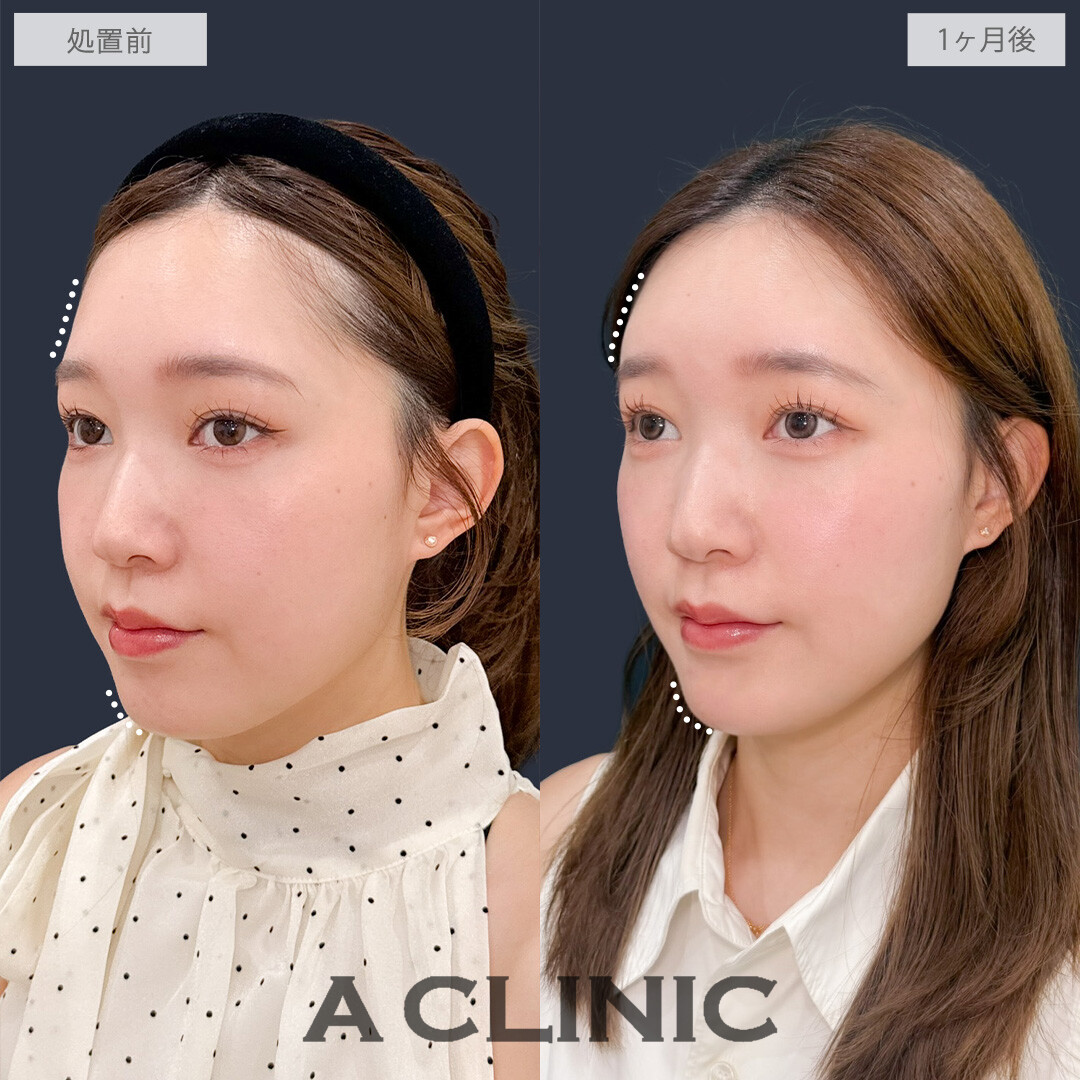 ヒアルロン酸カスタマイズメニューで凹みなくしてどの角度から見ても美しくなりました！こちら処置前と1ヶ月後の症例です(20代女性)