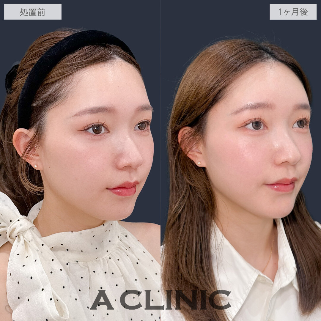 ヒアルロン酸カスタマイズメニューで凹みなくしてどの角度から見ても美しくなりました！こちら処置前と1ヶ月後の症例です(20代女性)