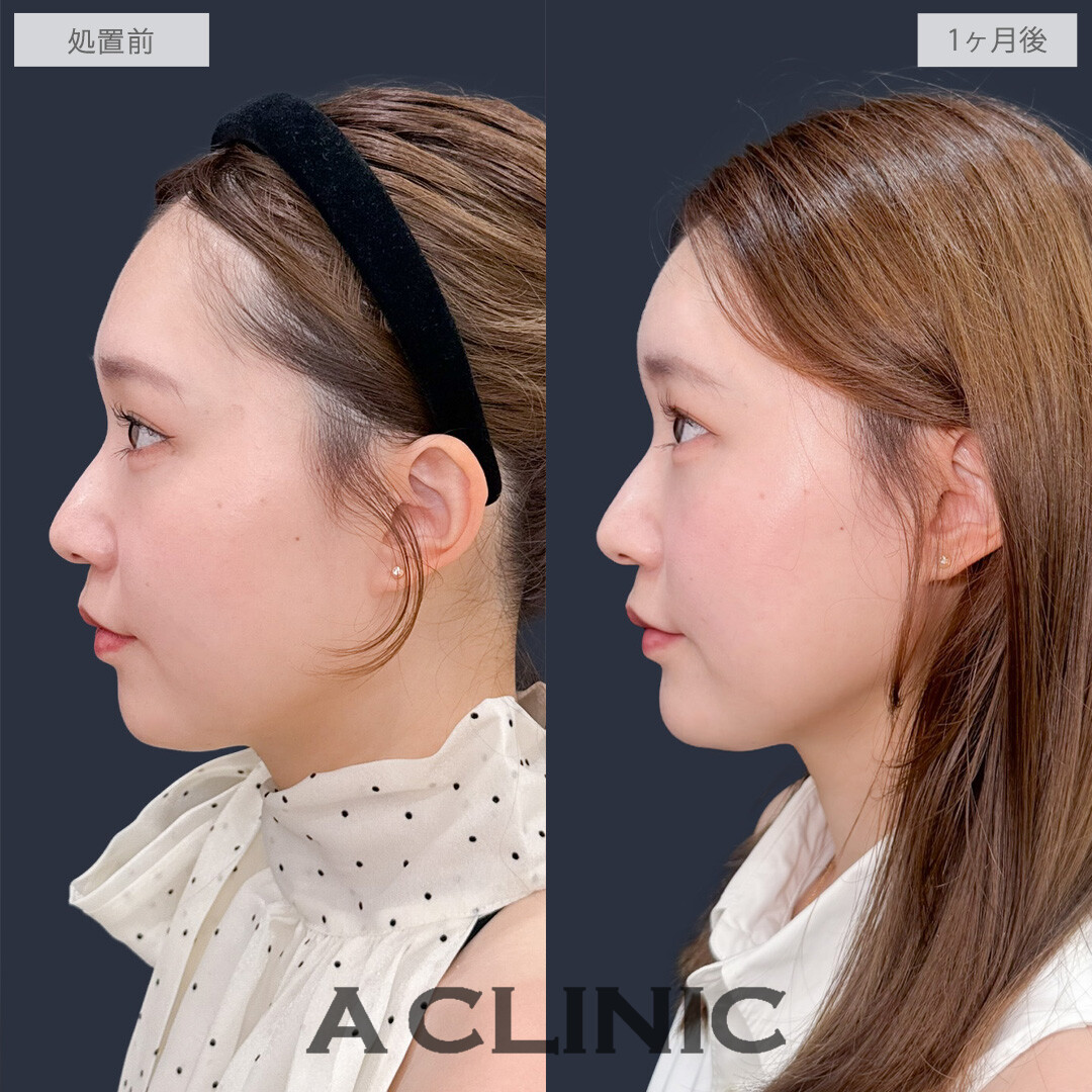 ヒアルロン酸カスタマイズメニューで凹みなくしてどの角度から見ても美しくなりました！こちら処置前と1ヶ月後の症例です(20代女性)