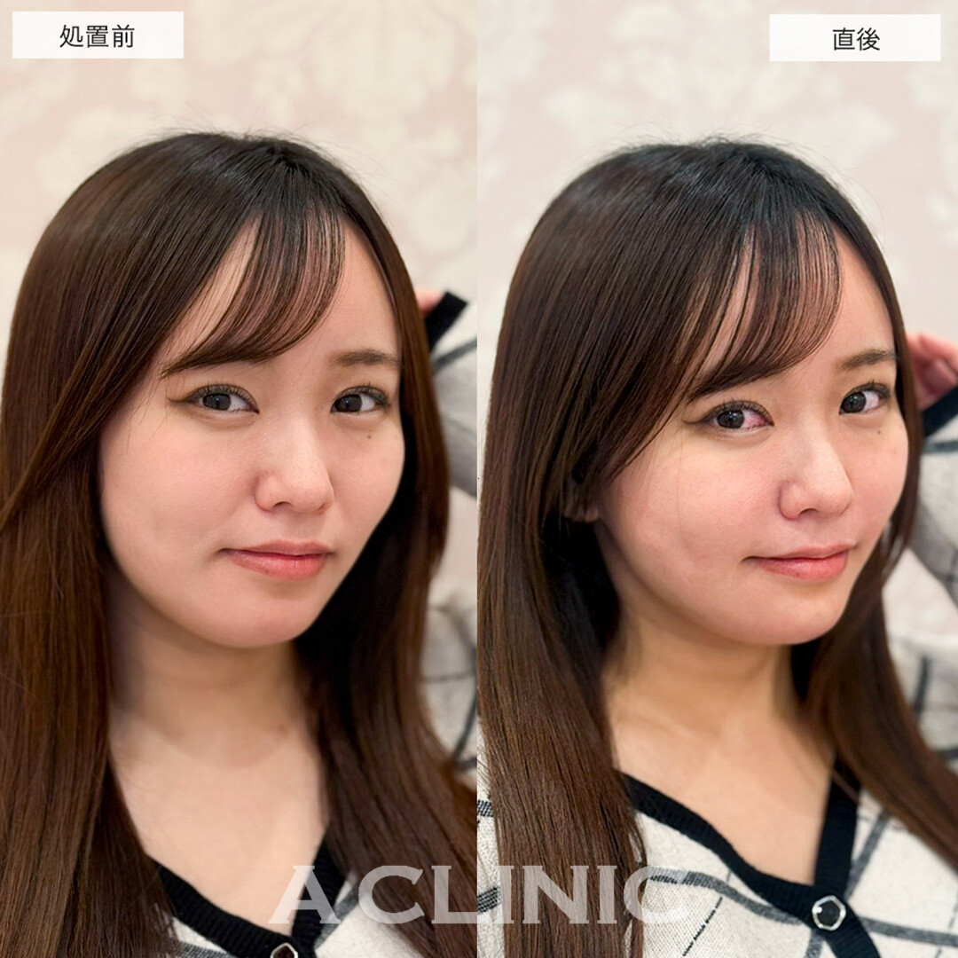 ヒアルロン酸カスタマイズメニューでほうれい線が薄くなりバランスが整いました!こちら処置前と直後の症例です(20代女性)