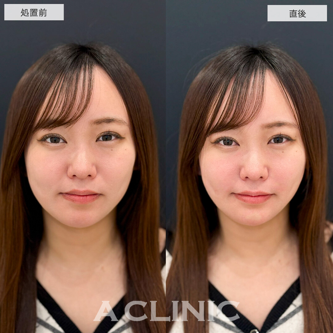ヒアルロン酸カスタマイズメニューでほうれい線が薄くなりバランスが整いました!こちら処置前と直後の症例です(20代女性)