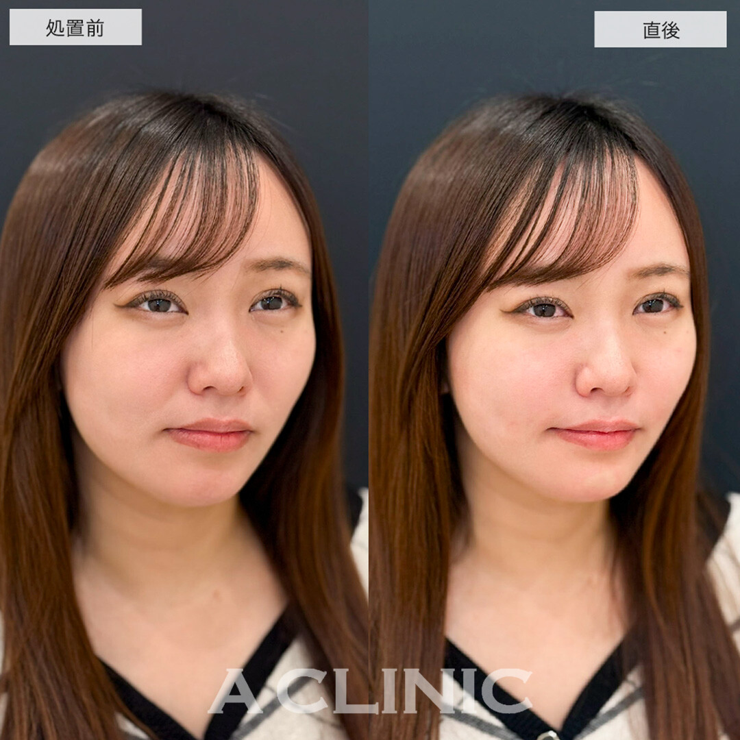 ヒアルロン酸カスタマイズメニューでほうれい線が薄くなりバランスが整いました!こちら処置前と直後の症例です(20代女性)