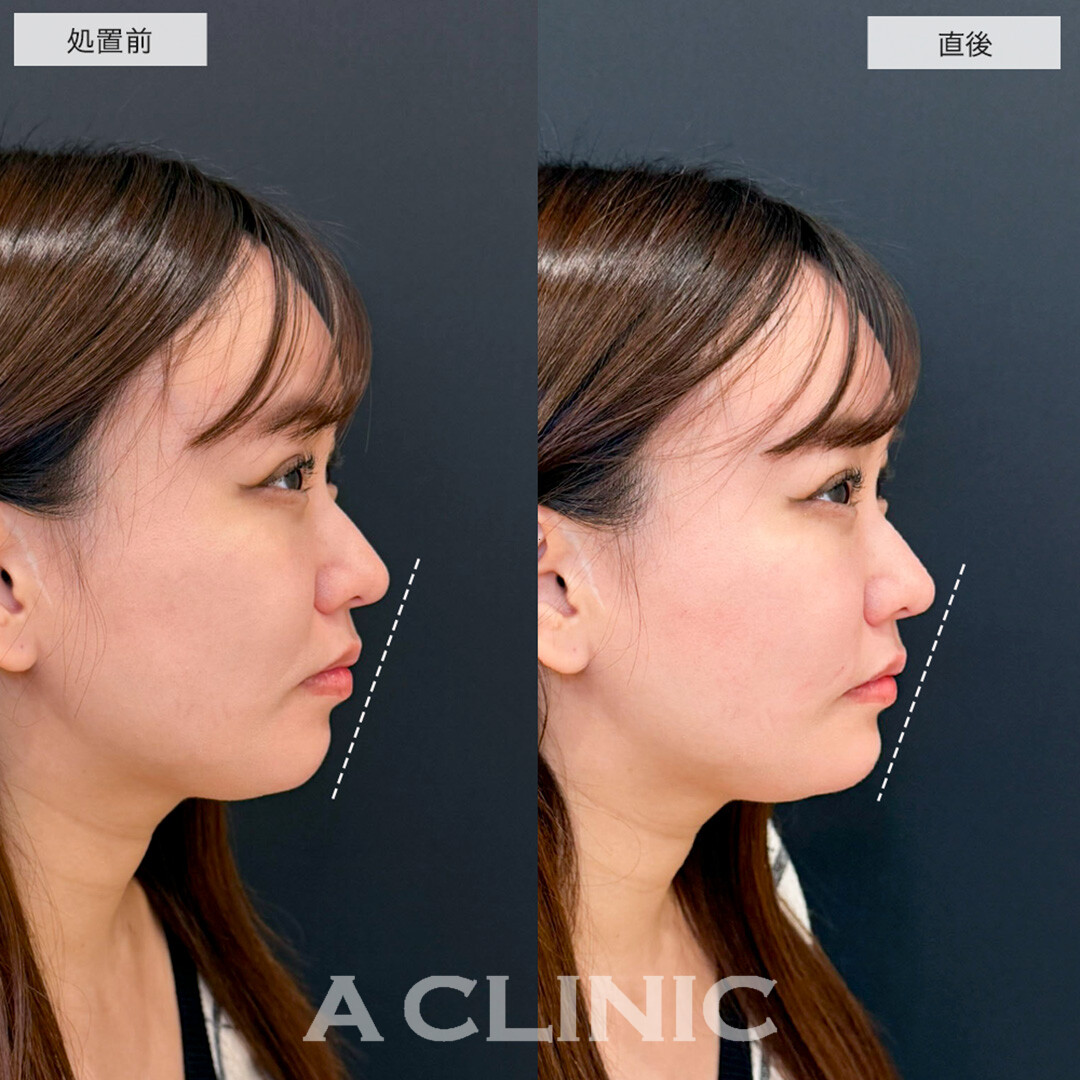 ヒアルロン酸カスタマイズメニューでほうれい線が薄くなりバランスが整いました!こちら処置前と直後の症例です(20代女性)