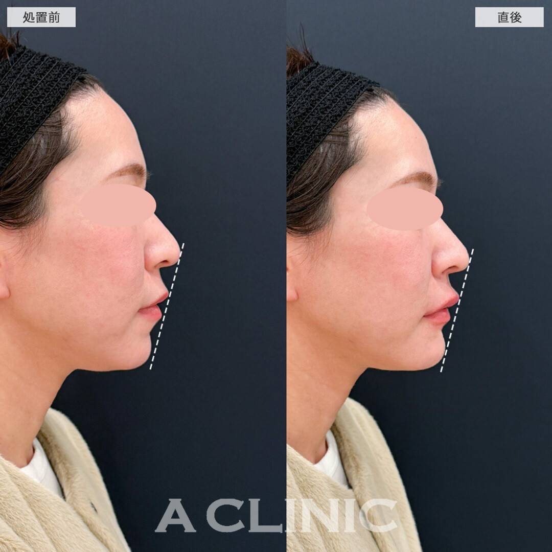 あごへのヒアルロン酸注入とコリアンノーズとリップへのヒアルロン酸でEラインを整える！こちら処置前と直後の症例です(30代女性)