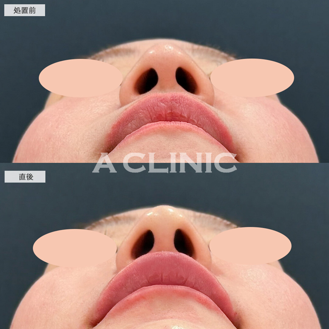 あごへのヒアルロン酸注入とコリアンノーズとリップへのヒアルロン酸でEラインを整える！こちら処置前と直後の症例です(30代女性)