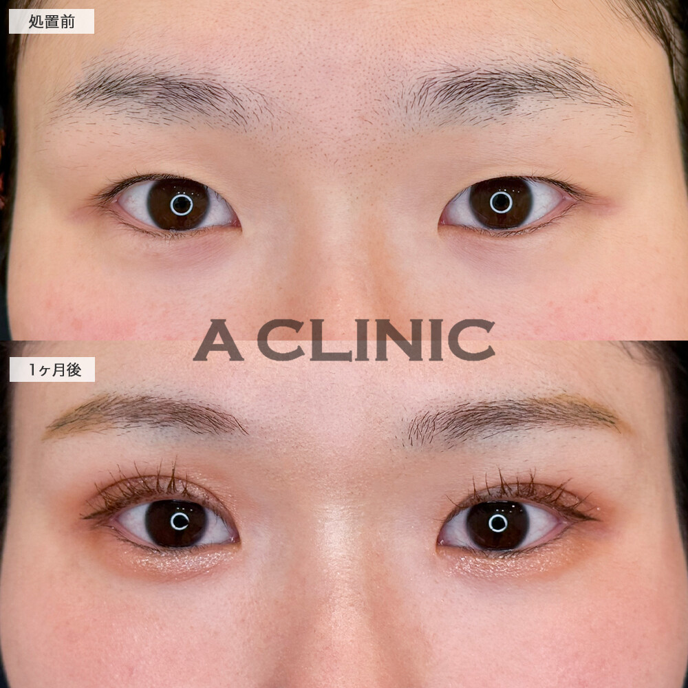 二重術埋没法で別人級のぱっちり目元に！処置前から1ヶ月後の症例です(20代女性)