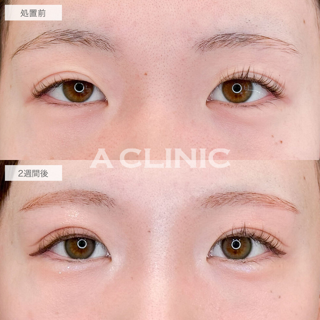 二重術埋没法で左右差を整えパッチリとした目元へ！こちら処置前と2週間後の症例です(20代女性)