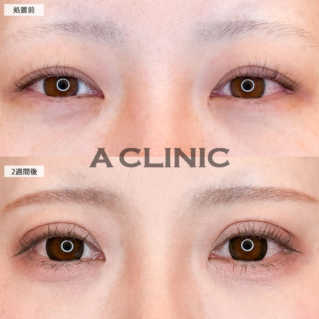 二重術埋没法できゅるんとしたお目元に！こちら処置前と2週間後の症例です(30代女性)