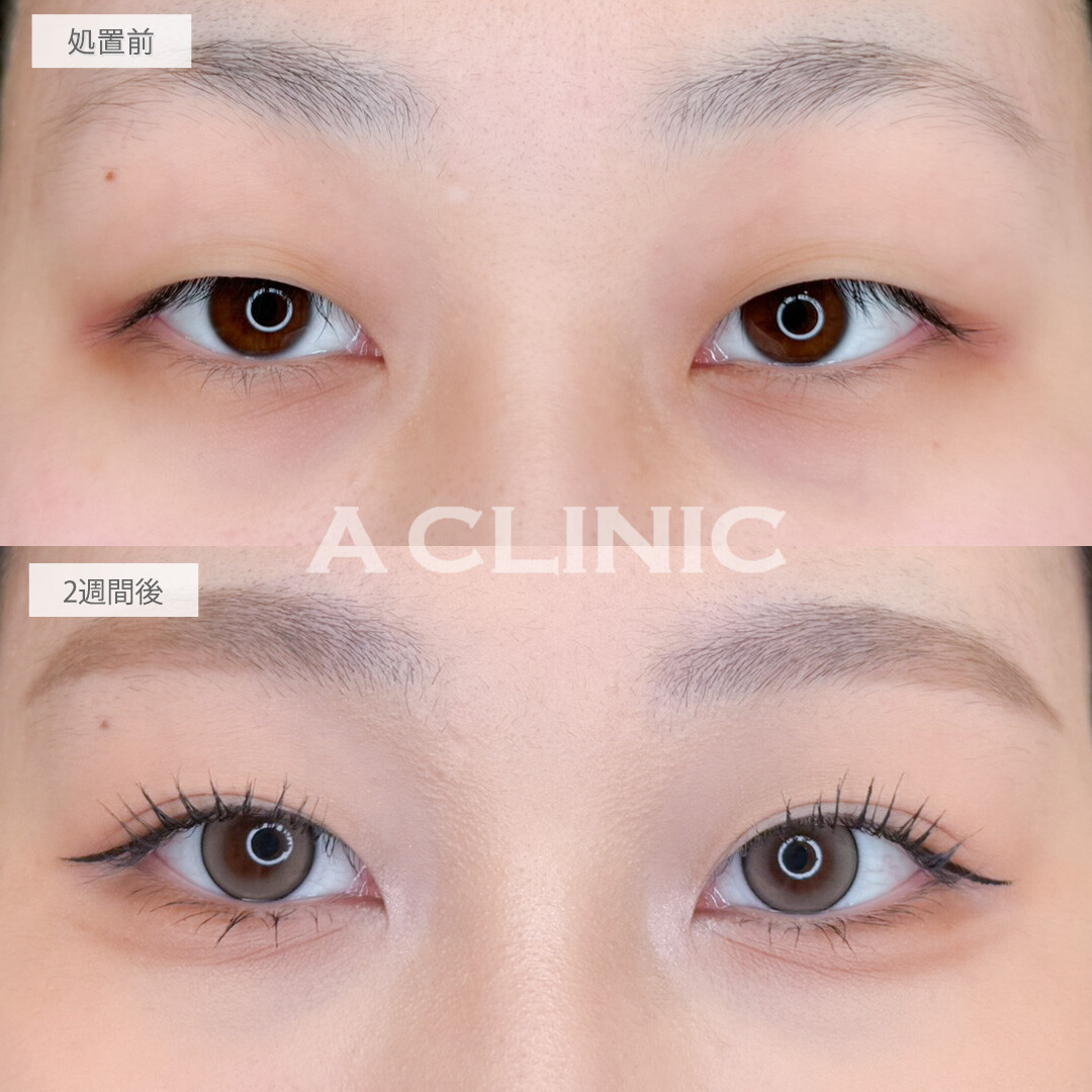 二重術埋没法で整形感のないかなりナチュラルな末広二重になれました！処置前と2週間後の症例です(20代女性)