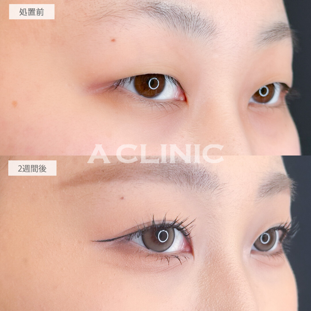 二重術埋没法で整形感のないかなりナチュラルな末広二重になれました！処置前と2週間後の症例です(20代女性)