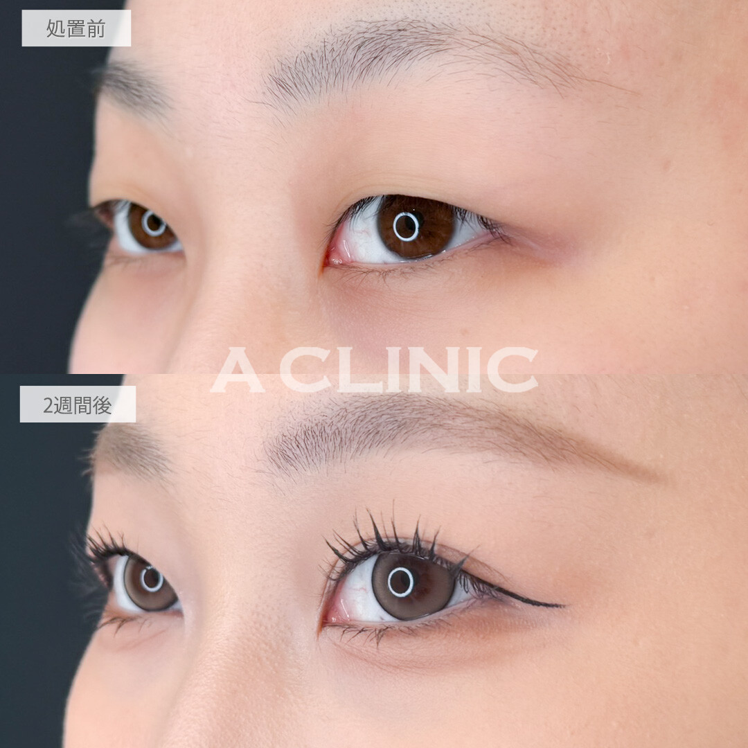 二重術埋没法で整形感のないかなりナチュラルな末広二重になれました！処置前と2週間後の症例です(20代女性)