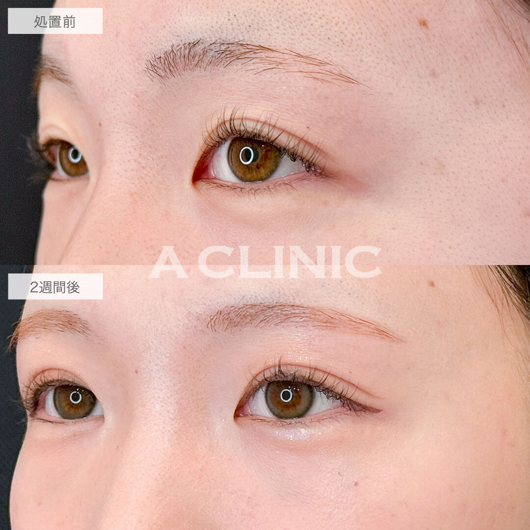 二重術埋没法で左右差を整えパッチリとした目元へ！こちら処置前と2週間後の症例です(20代女性)