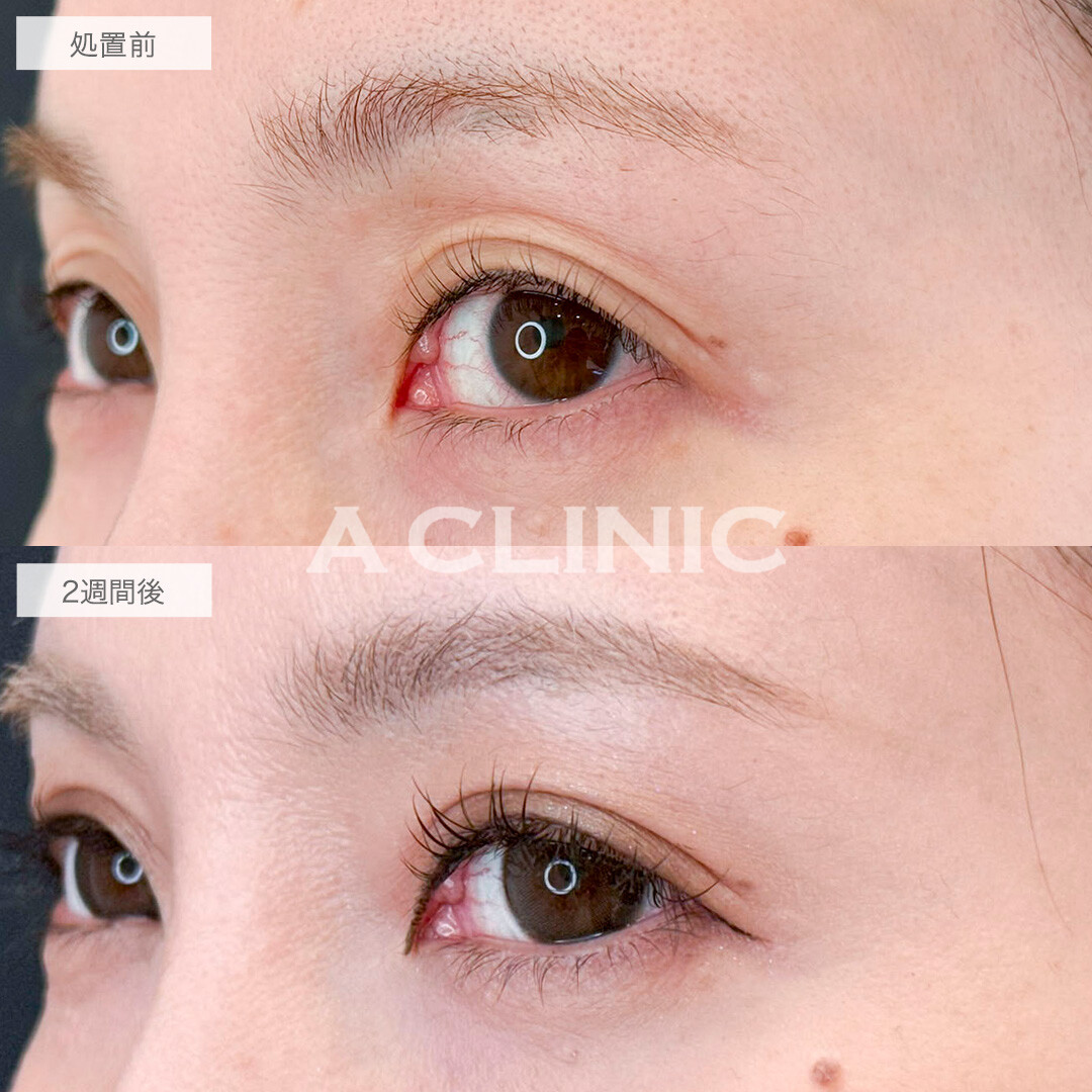 二重術埋没法で弛んだ瞼からぱっちり二重に！処置前と2週間後の症例です(40代女性)