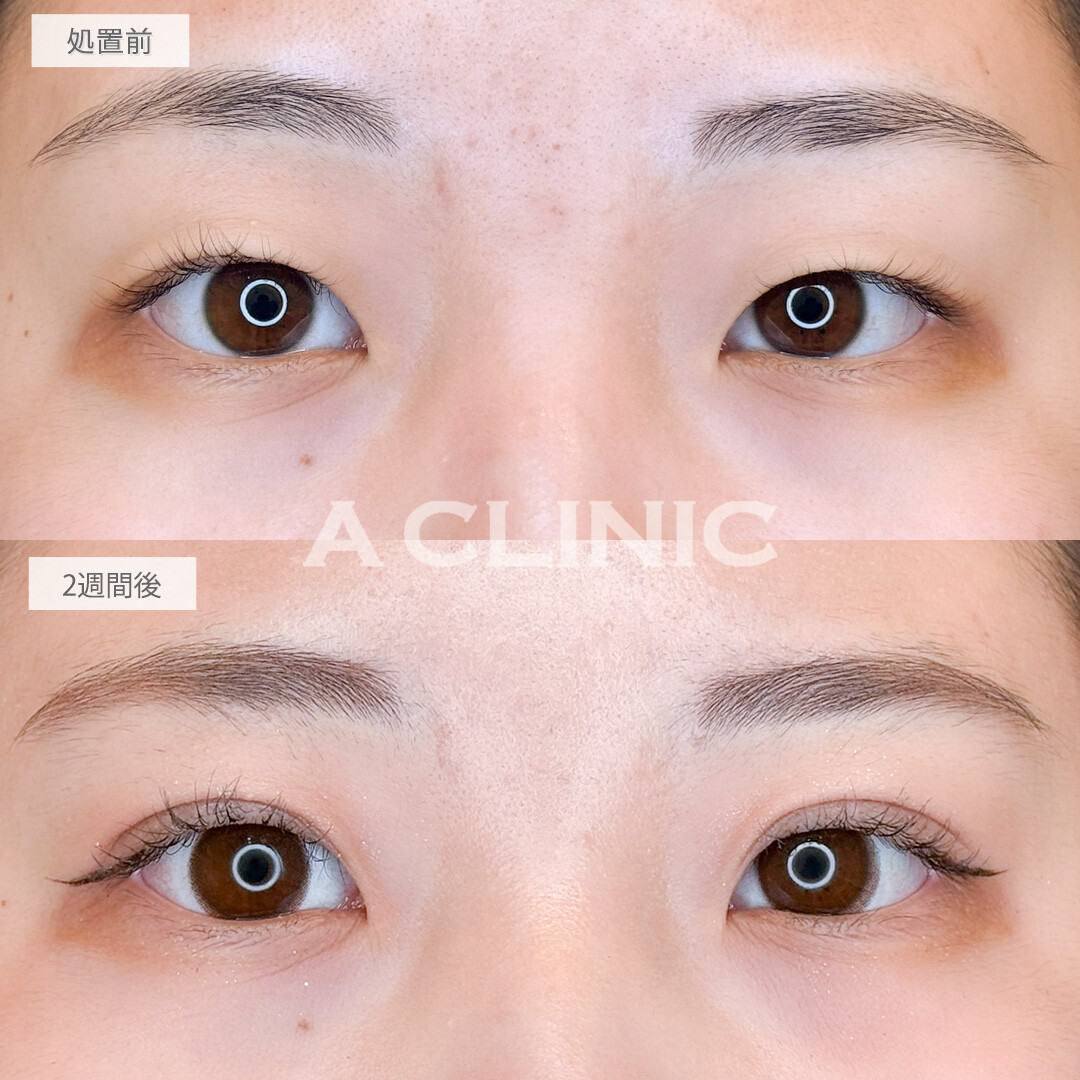二重術埋没法で一気にメイク映えする目元に！処置前と2週間後の症例です(10代女性)