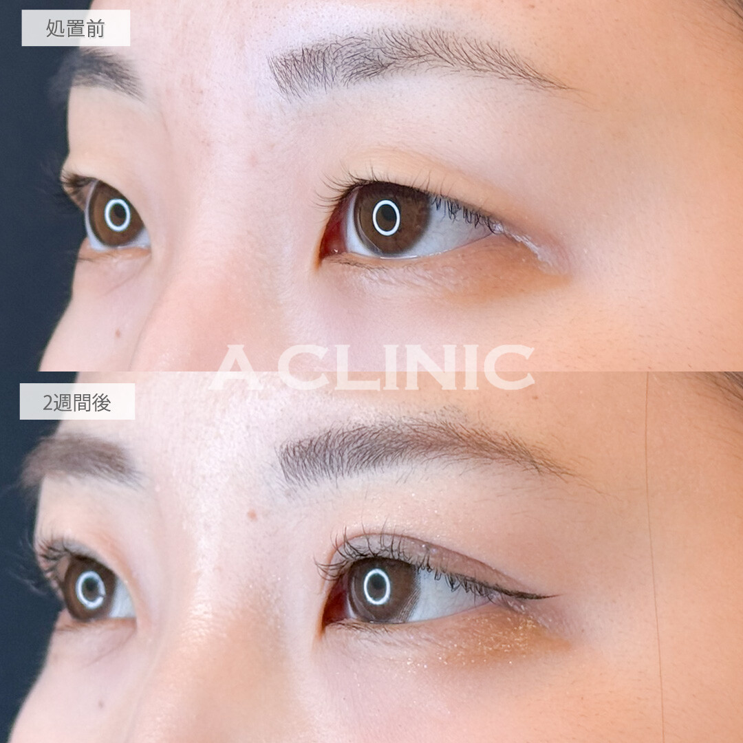 二重術埋没法で一気にメイク映えする目元に！処置前と2週間後の症例です(10代女性)