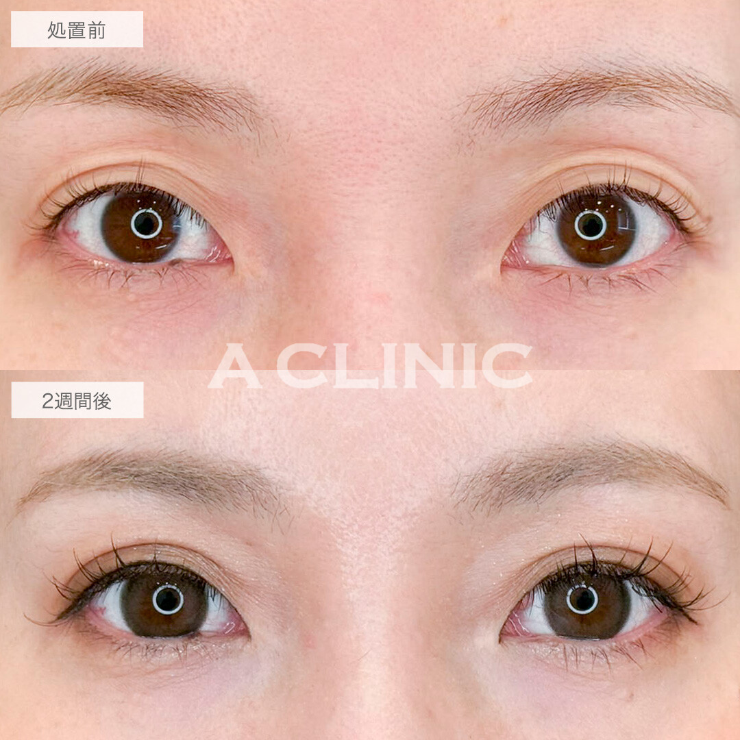 二重術埋没法で弛んだ瞼からぱっちり二重に！処置前と2週間後の症例です(40代女性)
