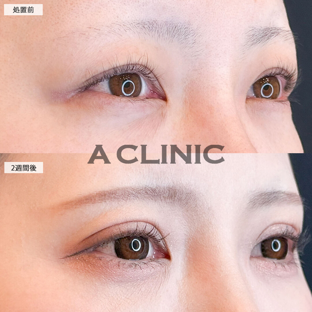 二重術埋没法できゅるんとしたお目元に！こちら処置前と2週間後の症例です(30代女性)