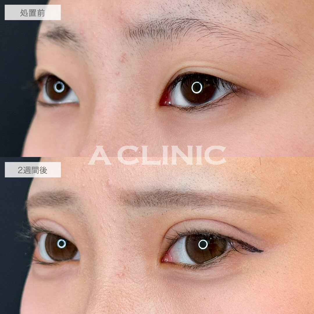 二重術埋没法で理想の平行二重になりました!こちら処置前と2週間後の症例です(10代女性)