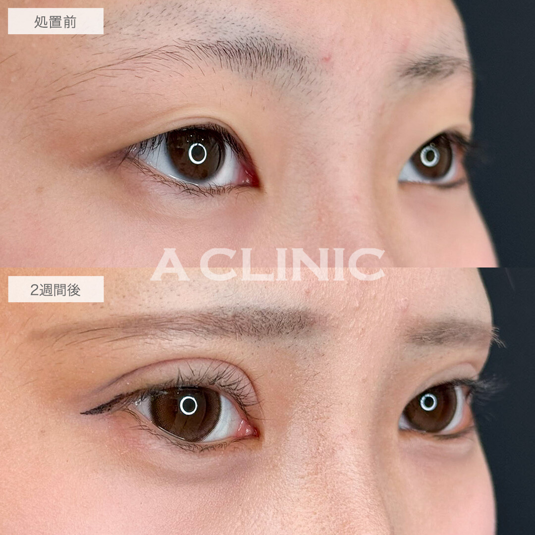 二重術埋没法で理想の平行二重になりました!こちら処置前と2週間後の症例です(10代女性)