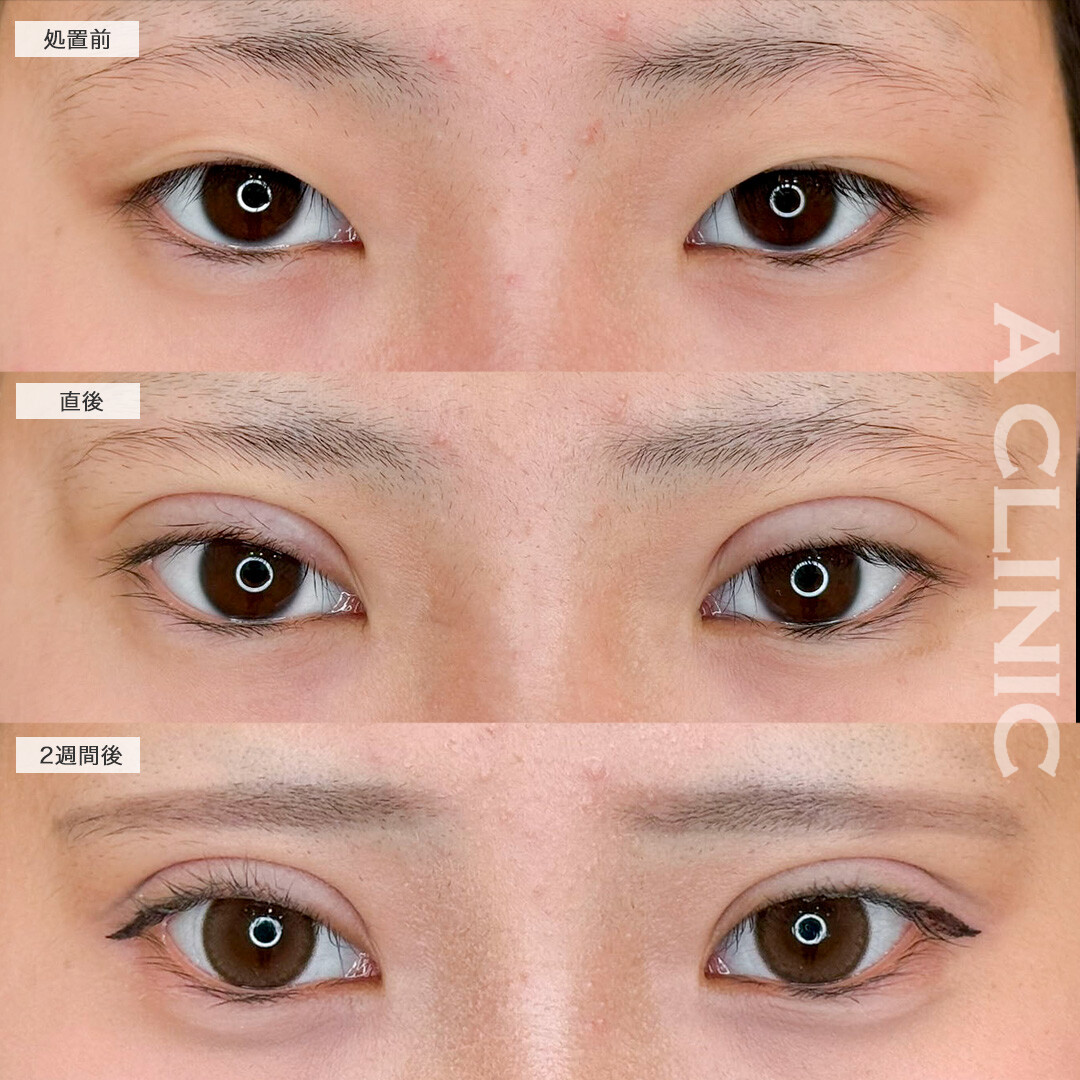 二重術埋没法で理想の平行二重になりました!こちら処置前と2週間後の症例です(10代女性)