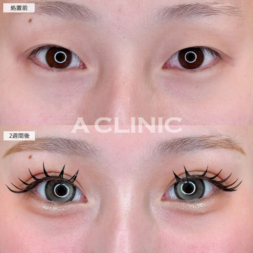 二重術埋没法でメイク映えする綺麗な二重になり垢抜け！こちら処置前と2週間後の症例です(20代女性)