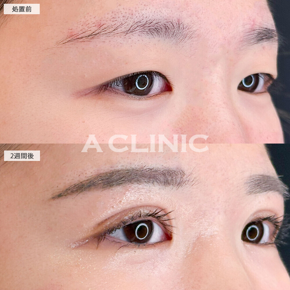 二重術埋没法でアイプチしなくてもパッチリ二重！こちら処置前と2週間後の症例です(10代女性)