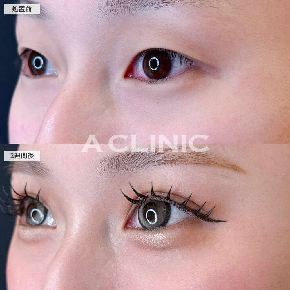 二重術埋没法でメイク映えする綺麗な二重になり垢抜け！こちら処置前と2週間後の症例です(20代女性)