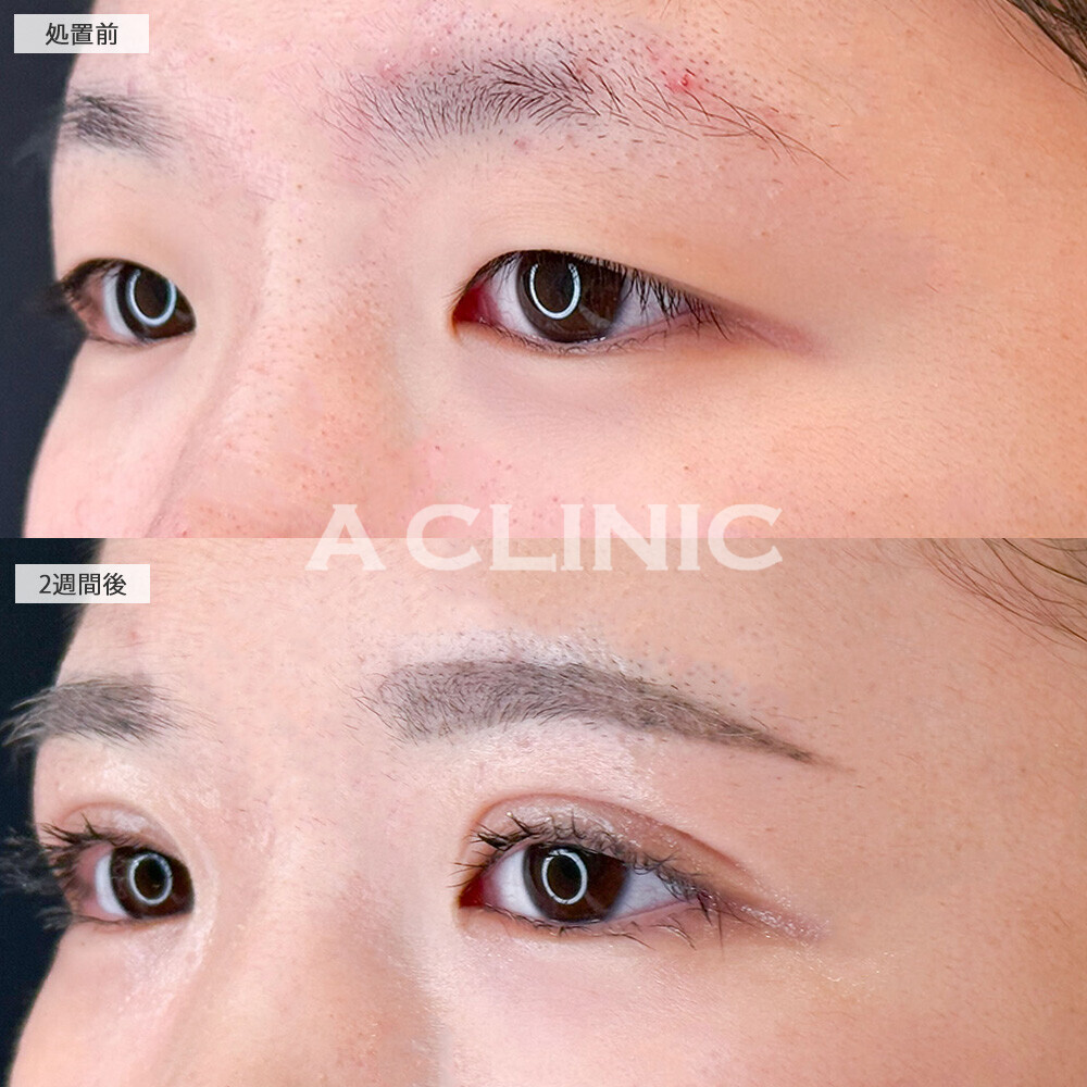 二重術埋没法でアイプチしなくてもパッチリ二重！こちら処置前と2週間後の症例です(10代女性)