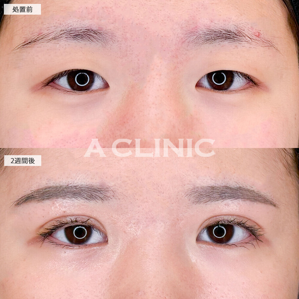 二重術埋没法でアイプチしなくてもパッチリ二重！こちら処置前と2週間後の症例です(10代女性)