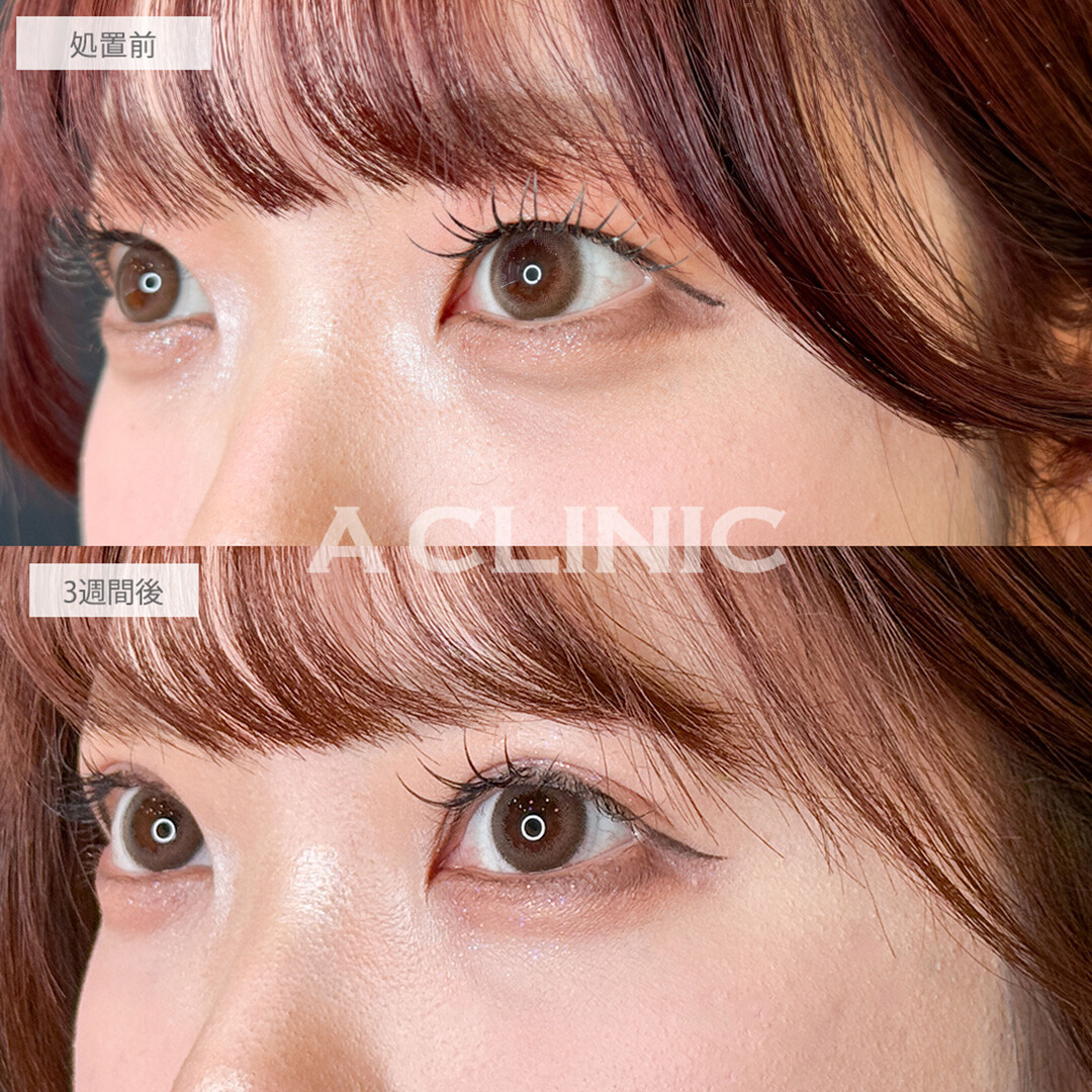 二重術埋没法でメイク映えする二重幅に！こちら処置前と3週間後の症例です(20代女性)