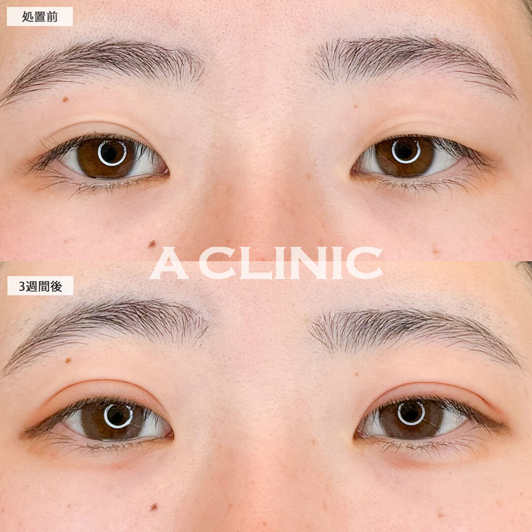 二重術埋没法で重たい瞼がぱっと明るいお目元に！こちら処置前と3週間後の症例です(10代女性)