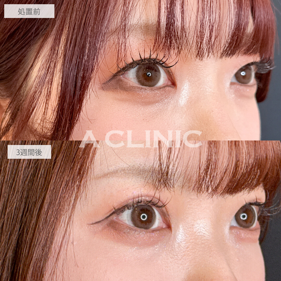 二重術埋没法でメイク映えする二重幅に！こちら処置前と3週間後の症例です(20代女性)