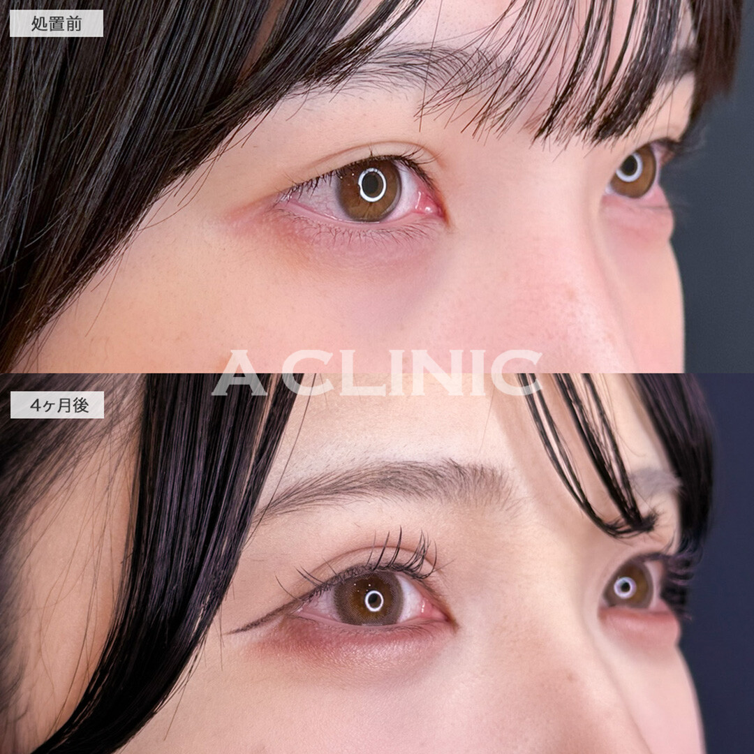 二重術埋没法ですっぴんでも盛れる二重に！こちら処置前から5ヶ月後の症例です(20代女性)