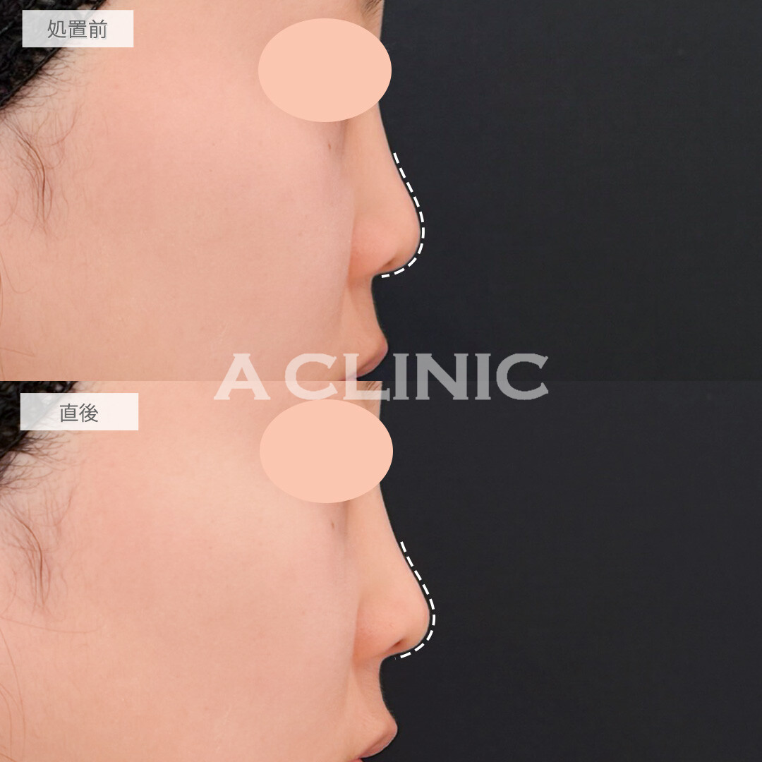 鼻ヒアルロン酸で不自然にならないようにナチュラルに鼻先を高くしてもらいました！処置前と直後の症例です(20代女性)