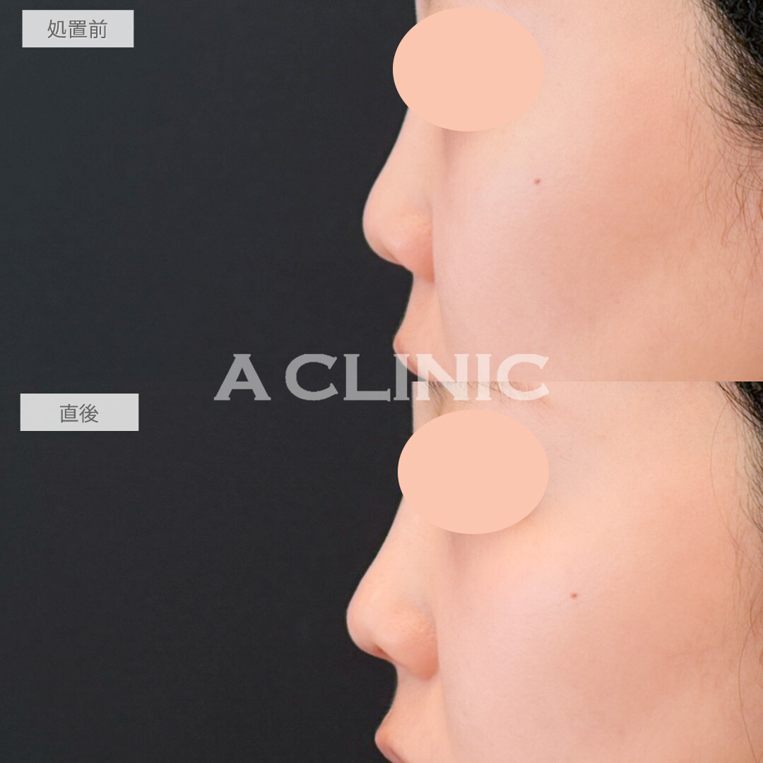 鼻ヒアルロン酸で不自然にならないようにナチュラルに鼻先を高くしてもらいました！処置前と直後の症例です(20代女性)