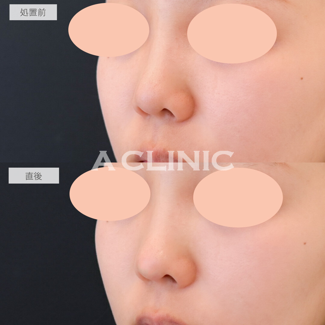 鼻ヒアルロン酸で不自然にならないようにナチュラルに鼻先を高くしてもらいました！処置前と直後の症例です(20代女性)