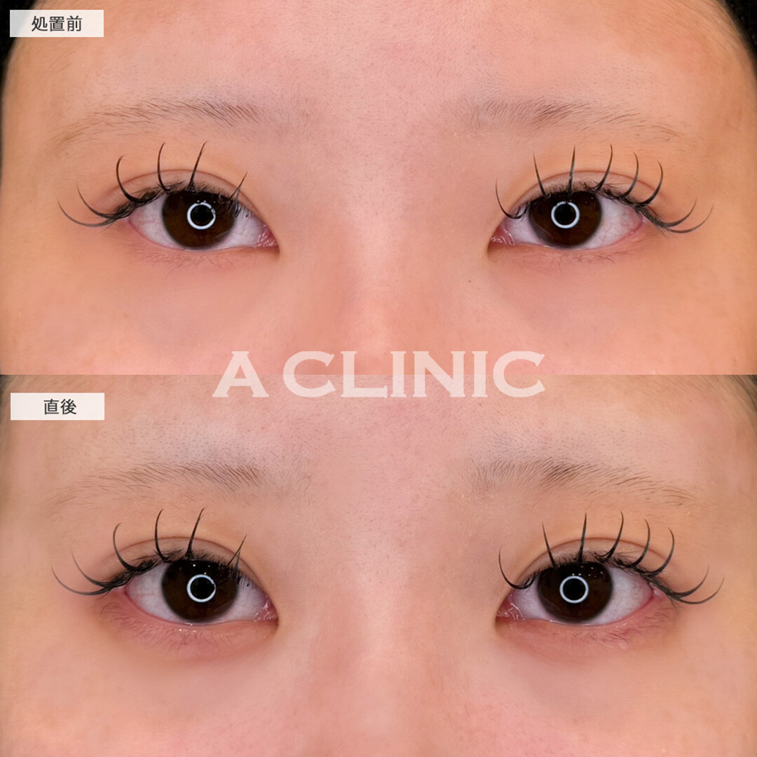 涙袋形成術(ヒアルロン酸)でさりげなく垢抜け！こちら処置前と直後の症例です(10代女性)