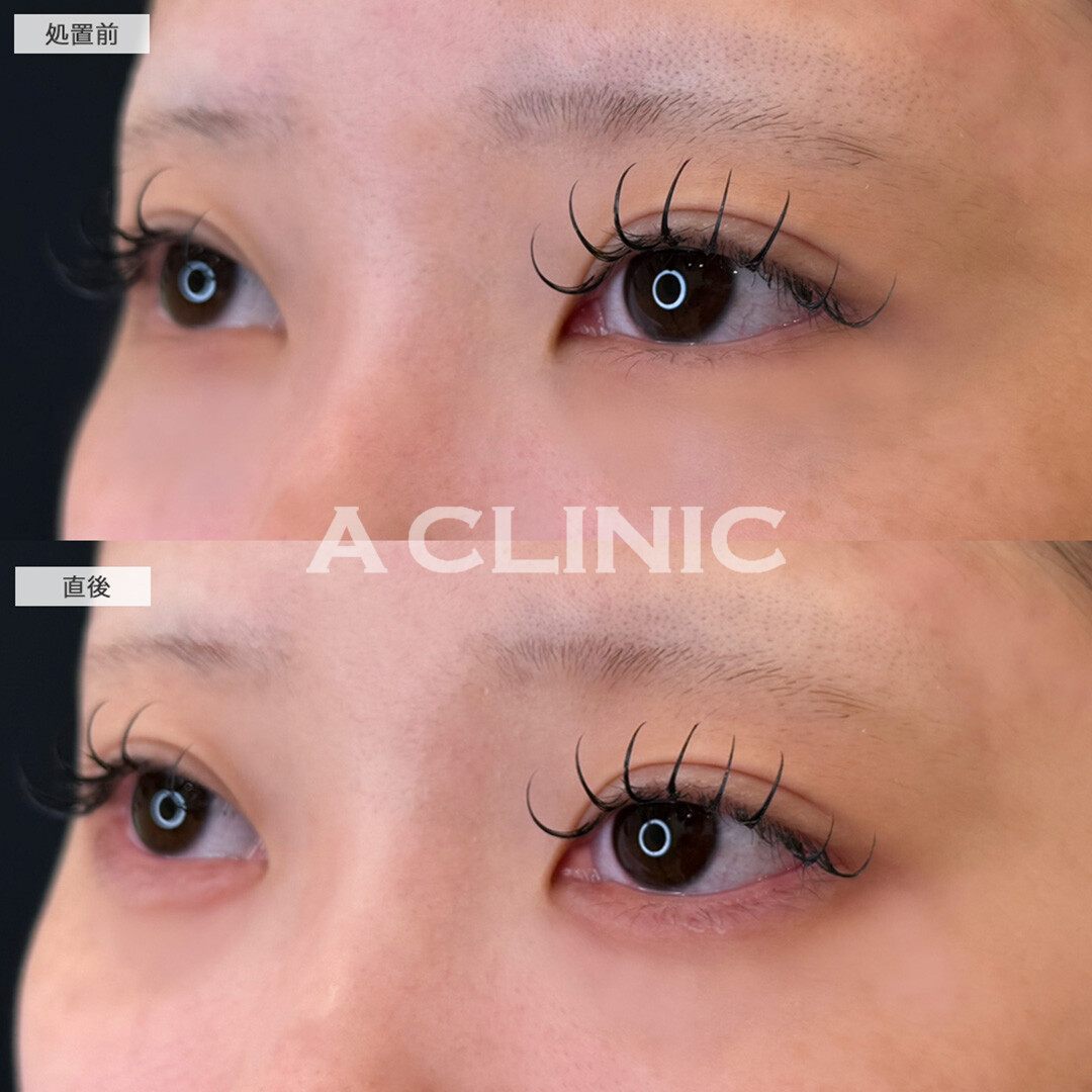 涙袋形成術(ヒアルロン酸)でさりげなく垢抜け！こちら処置前と直後の症例です(10代女性)