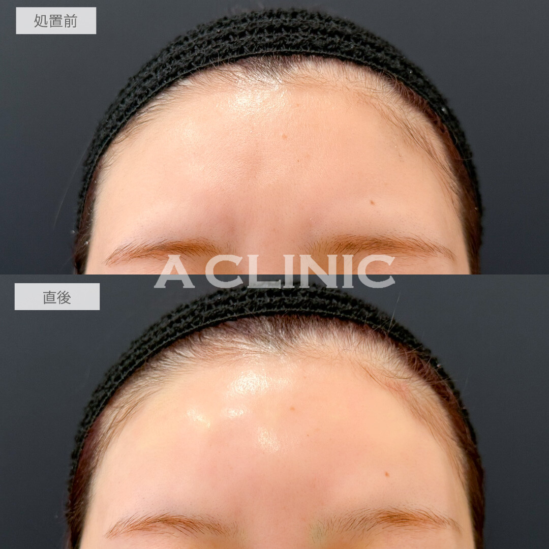 額出し、コメカミ形成(ヒアルロン酸注入)で丸みが出てお顔のバランスが一気に良くなりました！処置前と直後の症例です(30代女性)