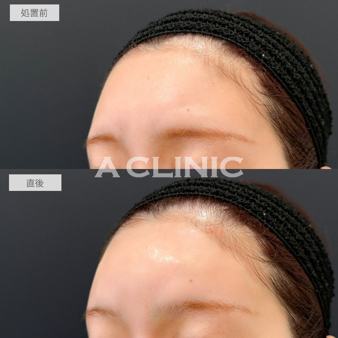 額出し、コメカミ形成(ヒアルロン酸注入)で丸みが出てお顔のバランスが一気に良くなりました！処置前と直後の症例です(30代女性)