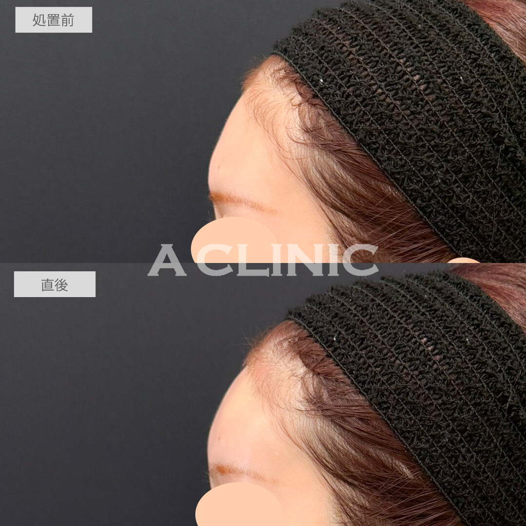 額出し、コメカミ形成(ヒアルロン酸注入)で丸みが出てお顔のバランスが一気に良くなりました！処置前と直後の症例です(30代女性)