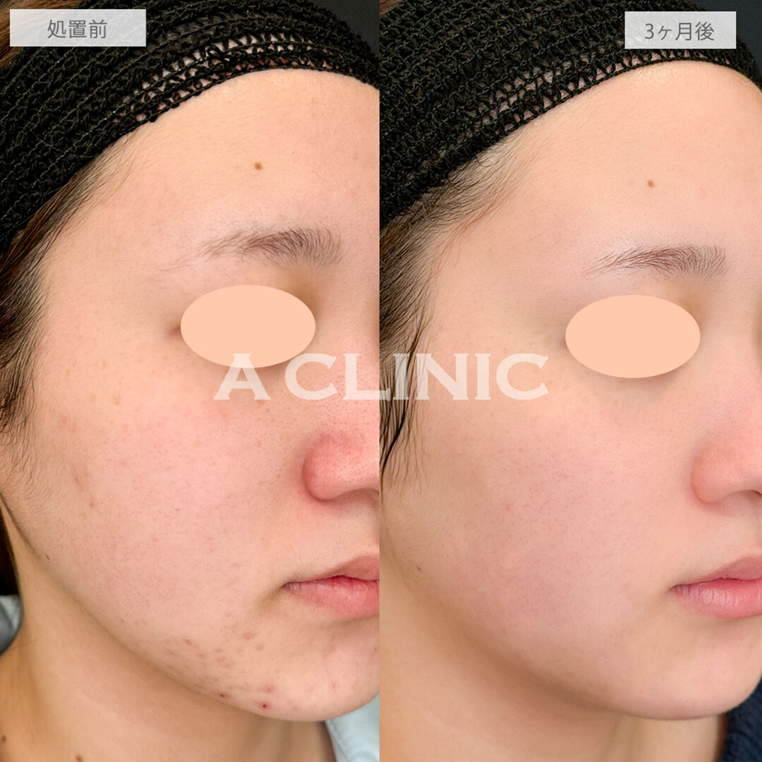 イソトレチノインでニキビが改善し肌の透明感がアップ！こちら処置前と3ヶ月後の症例です(20代女性)