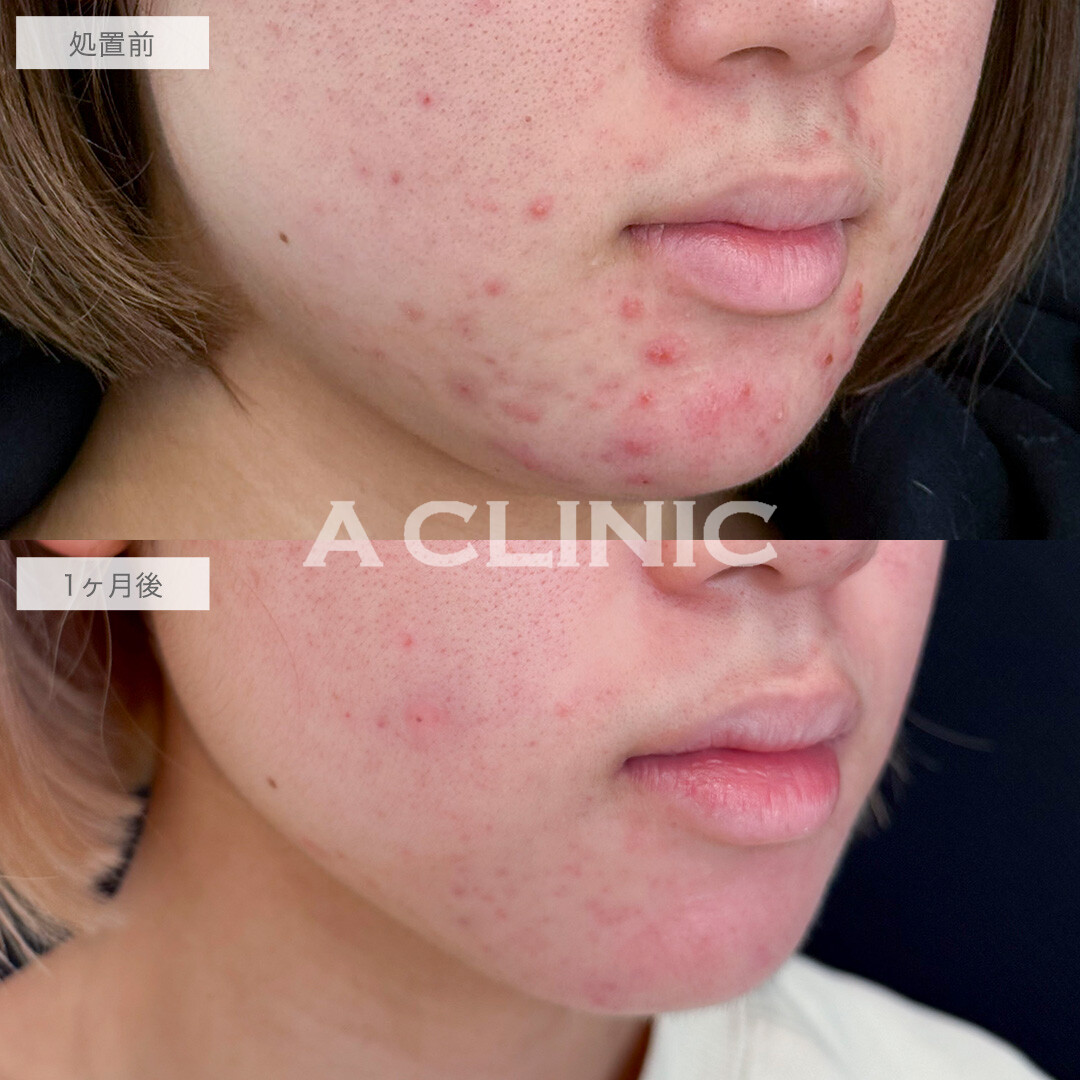 イソトレチノインで顎ニキビがかなりなくなりました！処置前と1ヶ月後の症例です(20代女性)